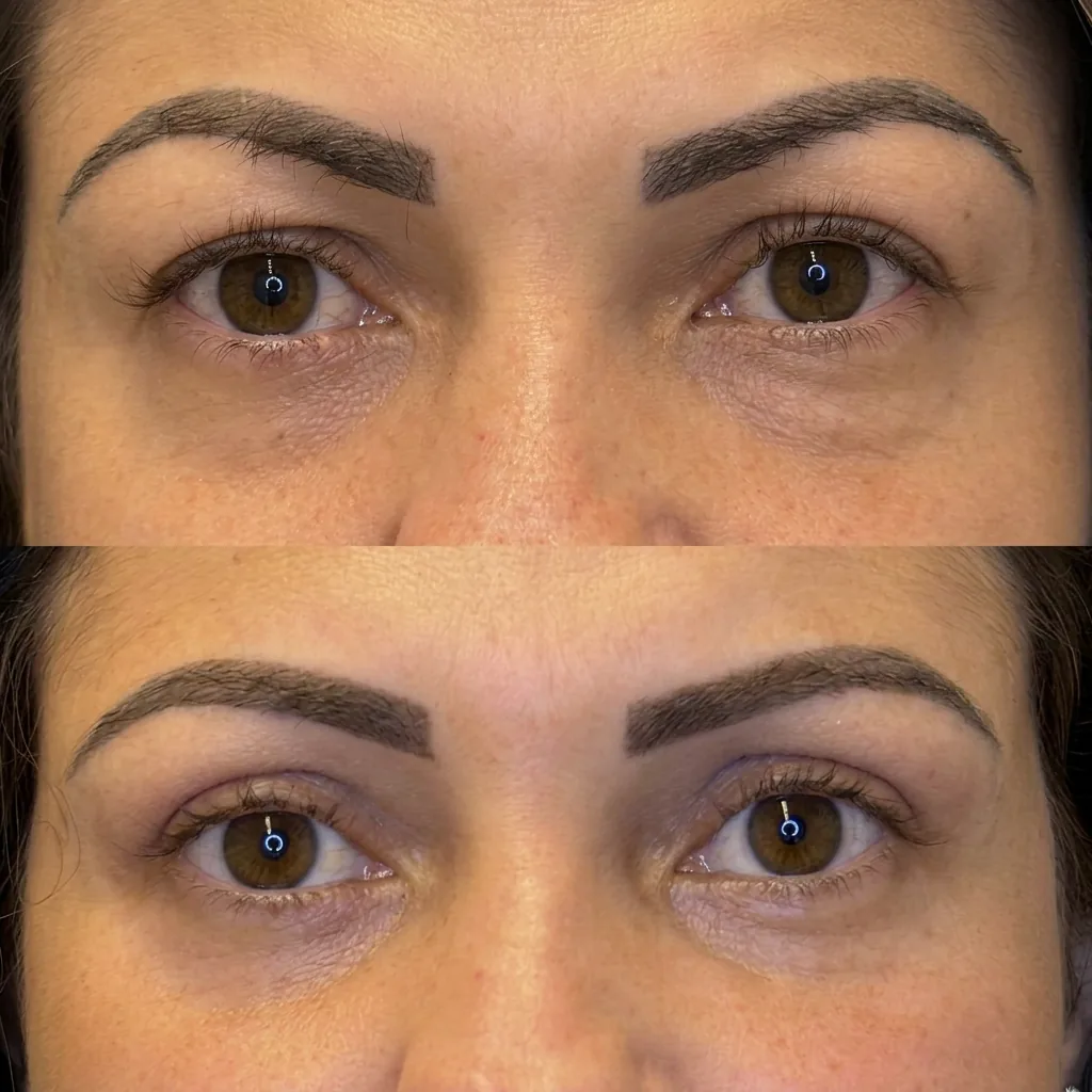 Antes e depois de blefaroplastia mostrando suavização das pálpebras